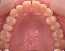 審美歯科 --- メタルフリートリートメント ---- 症例写真