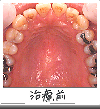 メタルフリートリートメント治療前