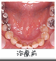 メタルフリートリートメント治療前