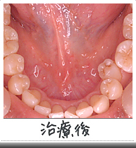 メタルフリートリートメント治療後