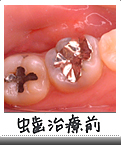 虫歯治療前