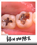 詰め物除去