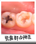 虫歯部分除去