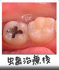 虫歯治療後