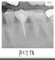 RCT後