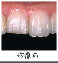 オールセラミックス治療前