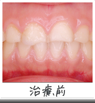 ラミネートベニア治療前