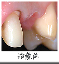 オールセラミックス治療前