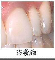 オールセラミックス治療後