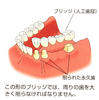 インプラント治療