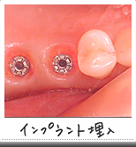インプラント埋入