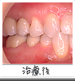 インプラント治療後