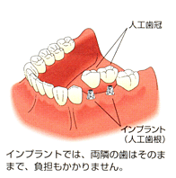 インプラント治療