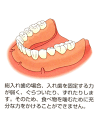 インプラント治療