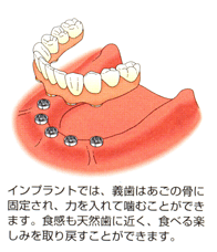 インプラント治療