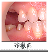 インプラント治療前